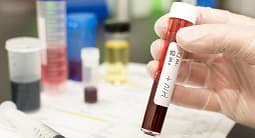 Në korrik janë regjistruar 11 raste të reja me HIV/AIDS, më i riu ka 20-vjeç Në korrik janë regjistruar 11 raste të reja me HIV/AIDS, më i riu ka 20-vjeç
