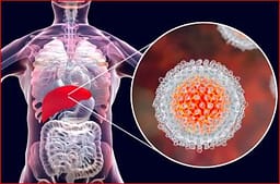 Anglia gati ta eliminojë hepatitn C Anglia gati ta eliminojë hepatitn C