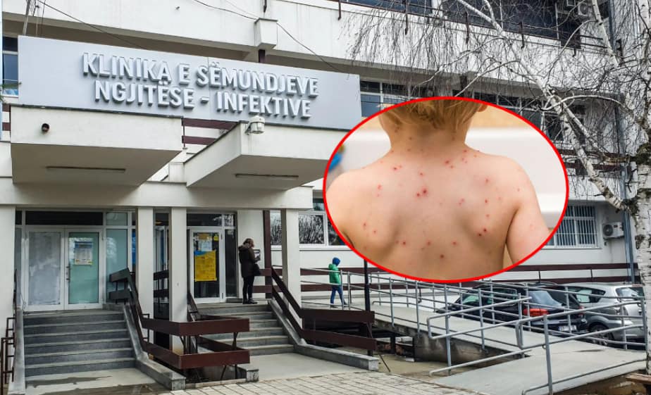 IKSHPK: Për një muaj janë konfirmuar 14 raste të fruthit, vaksinoni fëmijët – rreziku për komplikime është serioz IKSHPK: Për një muaj janë konfirmuar 14 raste të fruthit, vaksinoni fëmijët – rreziku për komplikime është serioz