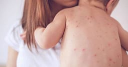 36 raste me fruth në dy muaj, IKShPK apelon për vaksinimin e fëmijëve 36 raste me fruth në dy muaj, IKShPK apelon për vaksinimin e fëmijëve