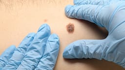 Dermatologët në Maqedoni zbulojnë raste të dyshimta të kancerit të lëkurës gjatë kontrolleve falas Dermatologët në Maqedoni zbulojnë raste të dyshimta të kancerit të lëkurës gjatë kontrolleve falas