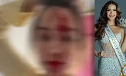 Fytyra e mbuluar me gjak, dhunohet “Miss Venezuela”, arrestohet stilisti i njohur Fytyra e mbuluar me gjak, dhunohet “Miss Venezuela”, arrestohet stilisti i njohur