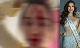Fytyra e mbuluar me gjak – dhunohet “Miss Venezuela”, arrestohet stilisti i njohur Fytyra e mbuluar me gjak – dhunohet “Miss Venezuela”, arrestohet stilisti i njohur